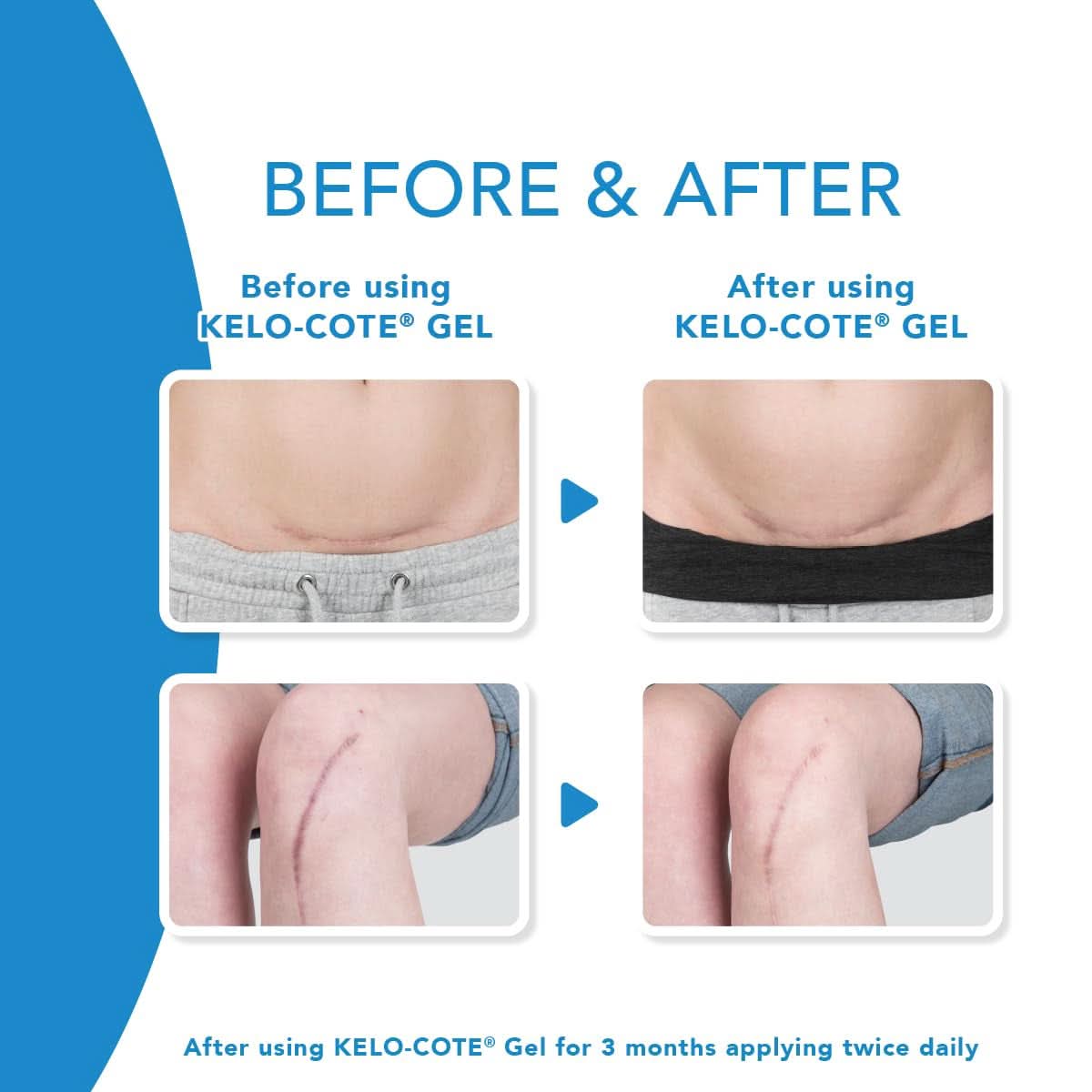 KELO-COTE® - Silicone gel for the treatment of scars Cosmetics and Beauty Naty Shop