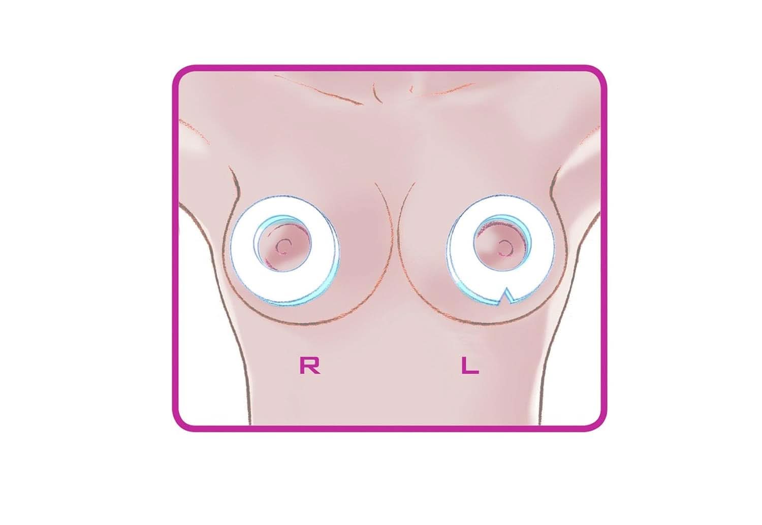 ELANEE Brust-Ringe, Schutz Der Brustwarze Bh-Kontakt Durch Hohllagerung, Ideal Bei Wunden, Entzündeten Brustwarzen Durch Stillen, 10 Stück (222-00) Accessories Food and Breastfeeding Bebe Naty Shop